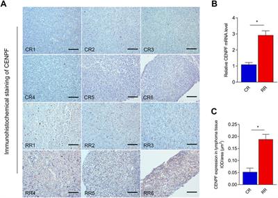 Combined multiomics analysis reveals the mechanism of CENPF overexpression-mediated immune dysfunction in diffuse large B-cell lymphoma in vitro